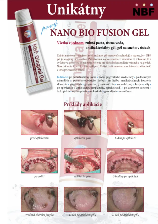 NBF Gingival  gél 30 g